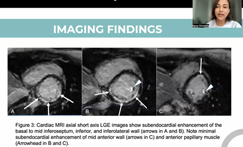 People’s choice award	Eosinophilic granulomatosis with polyangiitis